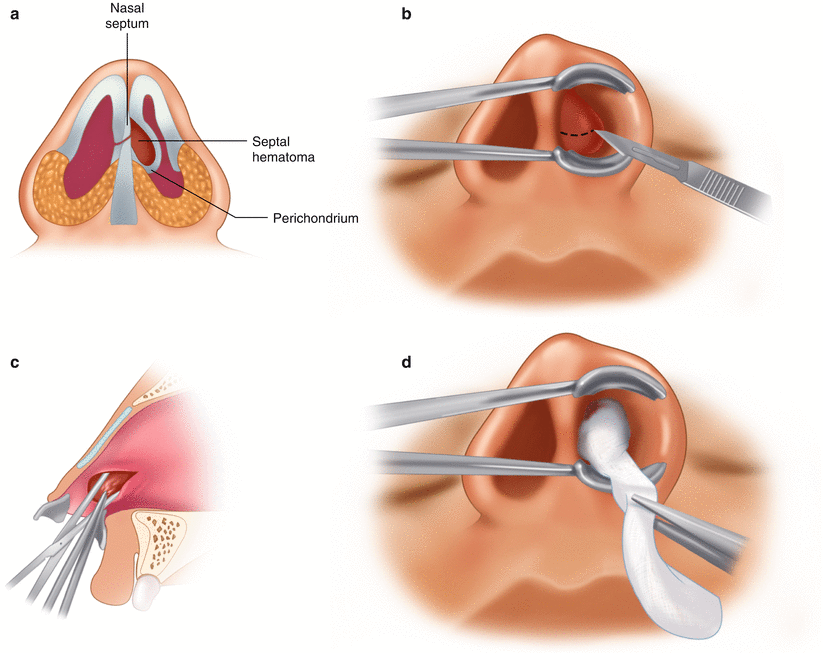 Treatment of Septal Hematoma | SpringerLink Treatment of Septal Hematoma | SpringerLink