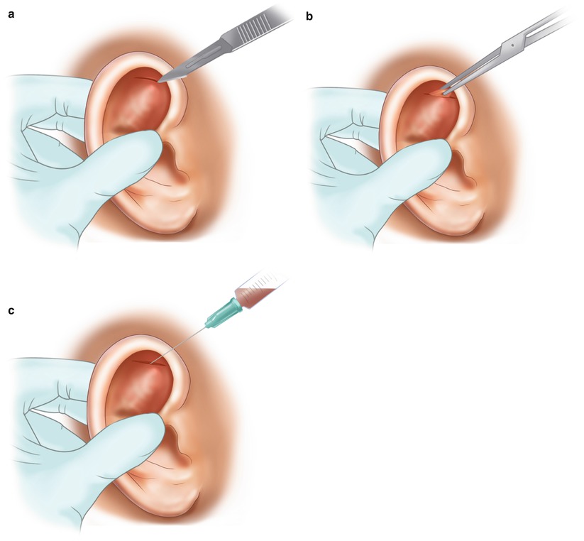 Treatment Of Auricular Hematoma Springerlink