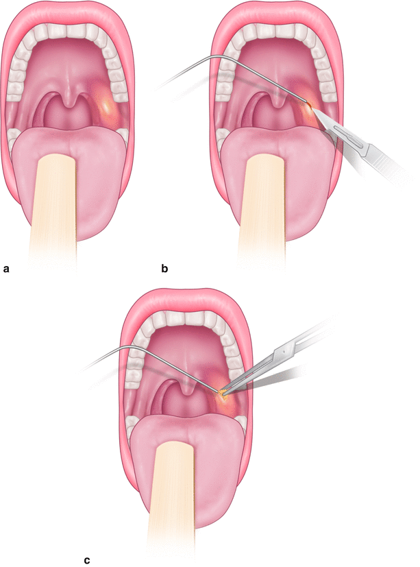 Incision And Drainage Of Peritonsillar Abscess Springerlink