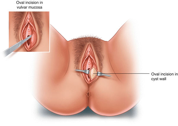 Bartholin Gland Abscess/Cysts Drainage | SpringerLink Bartholin Gland Abscess/Cysts Drainage | SpringerLink