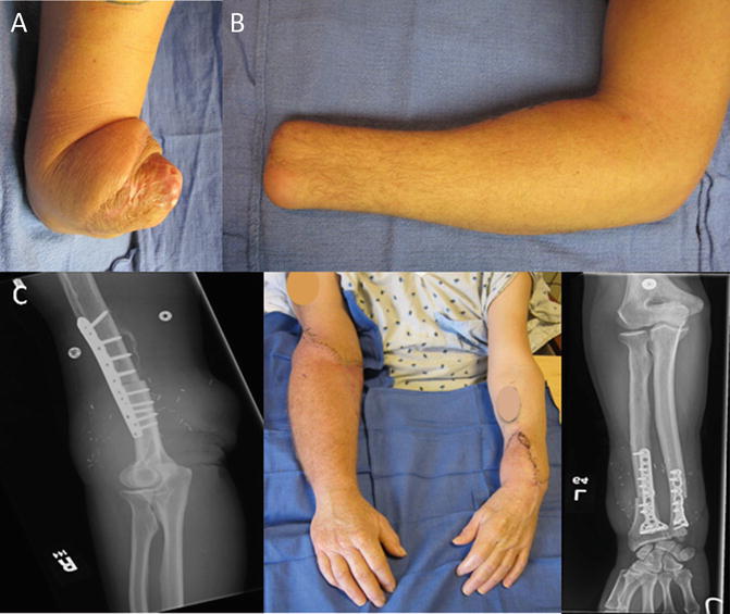 Limb Transplantation Springerlink