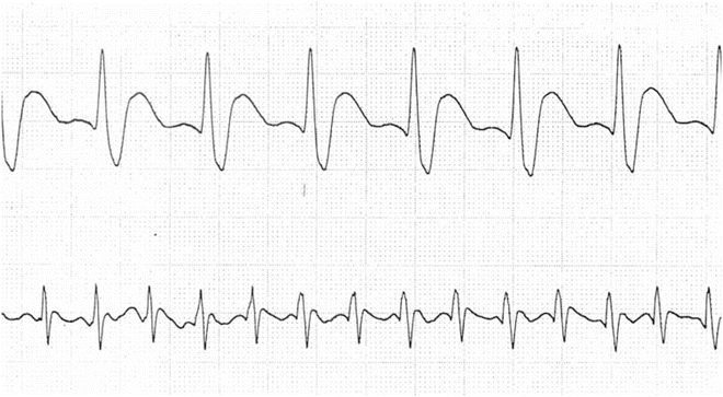 cardiac sick sinus syndrome cardiac sick sinus syndrome