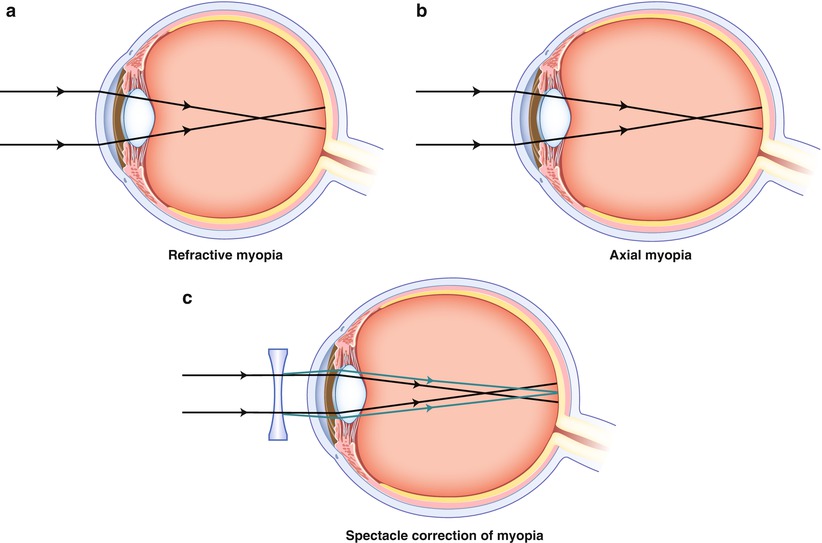 myopia pupilla tónusú látás helyreállítása