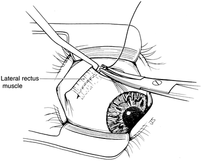 A V Pattern Strabismus