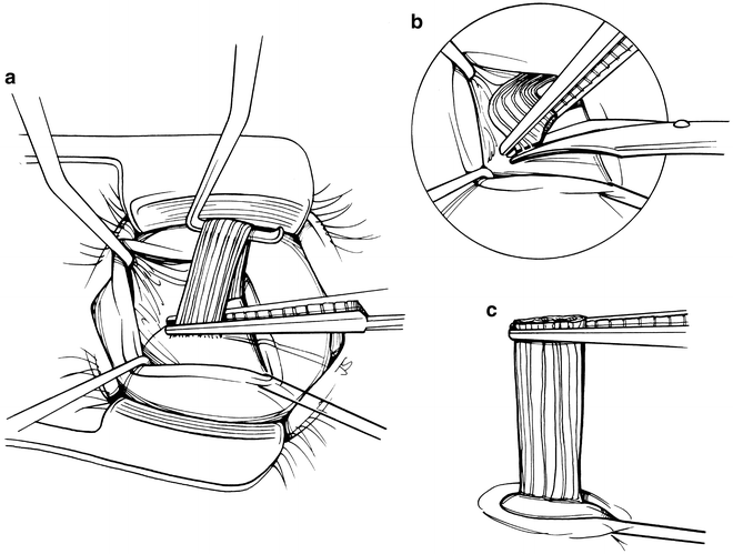 A And V Pattern Strabismus Springerlink