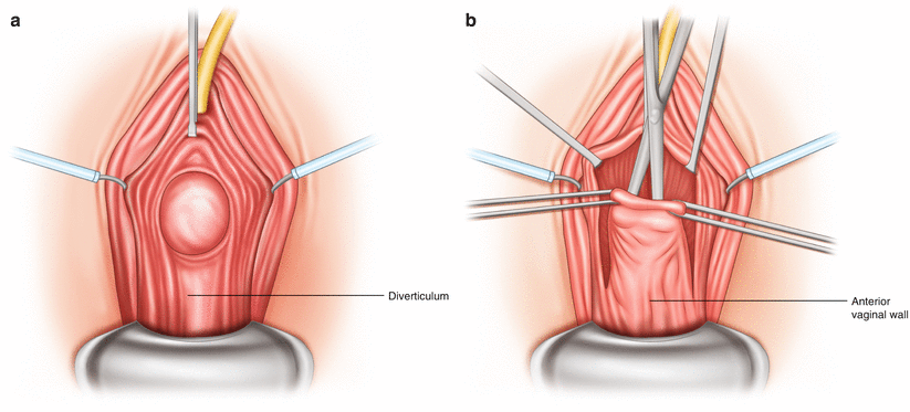 Excision Of Urethral Diverticula Springerlink