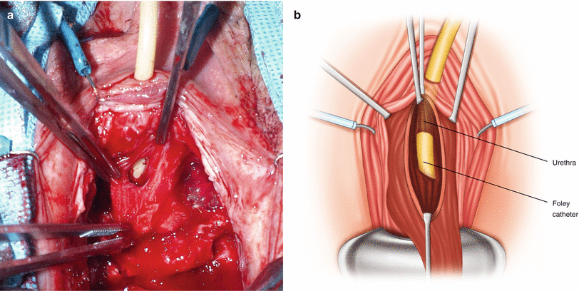 Excision Of Urethral Diverticula Springerlink
