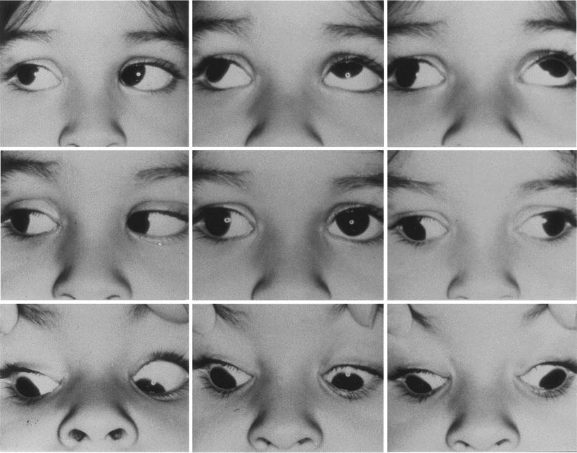 Ocular Motor Nerve Palsies In Children Springerlink - 