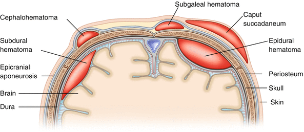 Birth Trauma To The Scalp And Skull Springerlink