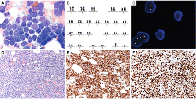 Recurrent Abnormalities in NonHodgkin’s