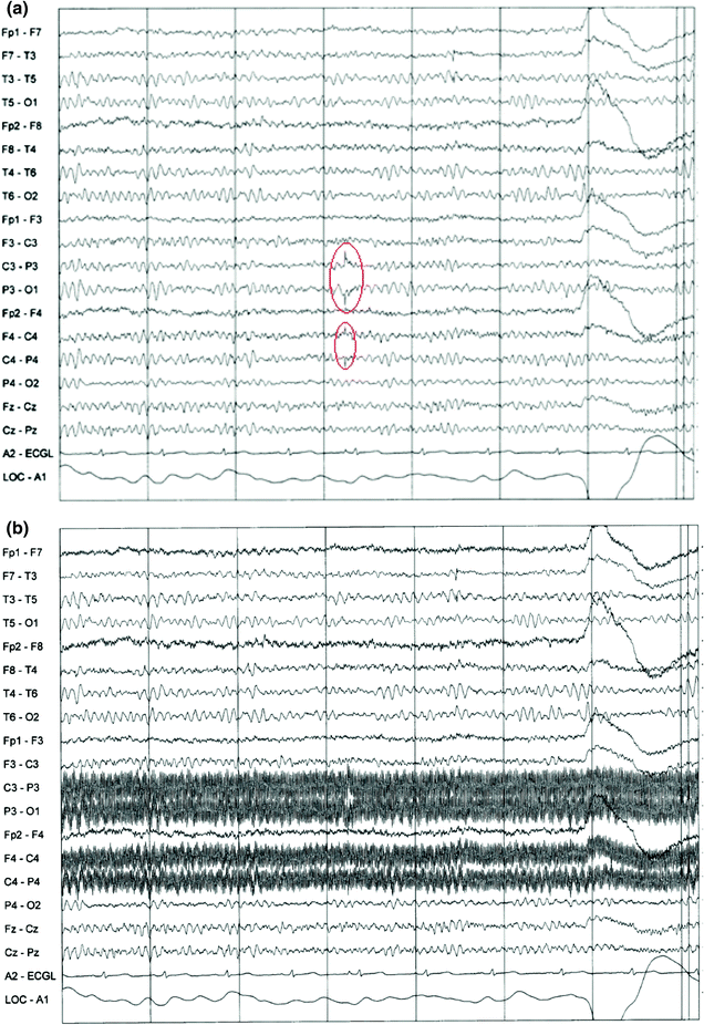 EEG Instrumentation, Montage, Polarity, and Localization SpringerLink