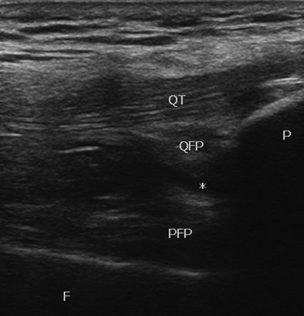 Ultrasound Guided Knee Injections SpringerLink Ultrasound Guided Knee Injections SpringerLink