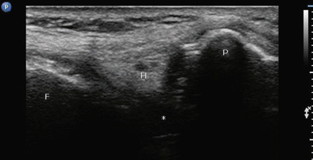 Ultrasound Guided Knee Injections SpringerLink Ultrasound Guided Knee Injections SpringerLink