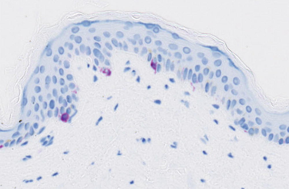 lymphoid papillomatosis patológia körvonalai)