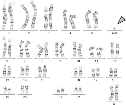 Characterization of Prenatally Assessed De Novo Small Supernumerary