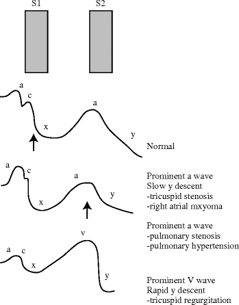Physical Examination In Valvular Heart Disease Springerlink Physical Examination In Valvular Heart Disease Springerlink