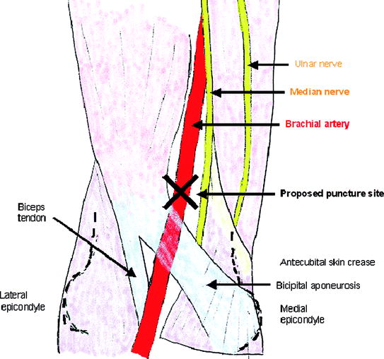 Vascular Access: Femoral, Radial, Brachial, and Direct Carotid Approach ...