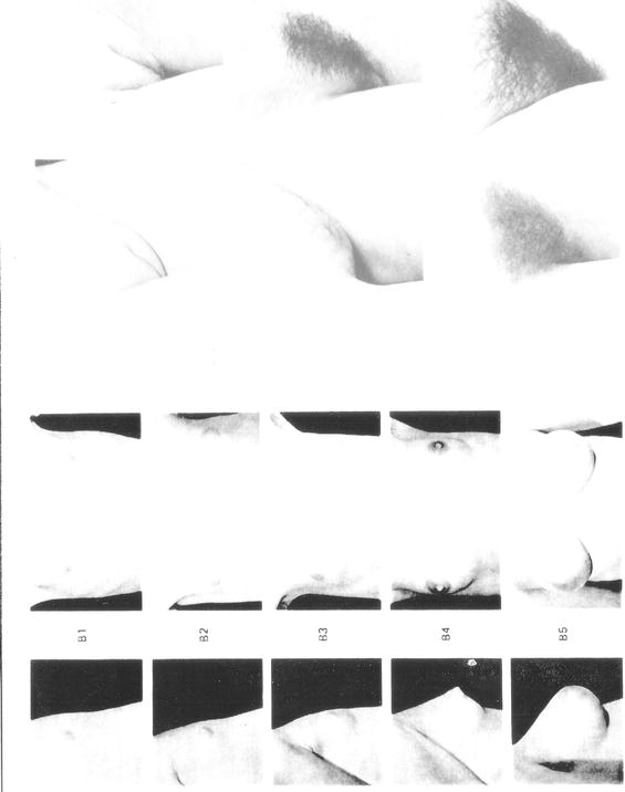 Precocious Puberty Clinical Management SpringerLink