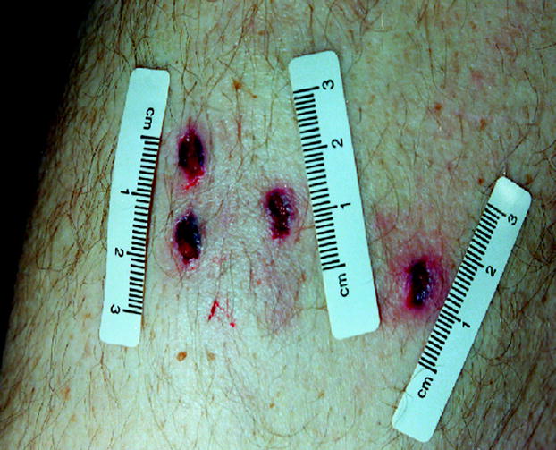 Sharp Force Injury Deaths SpringerLink