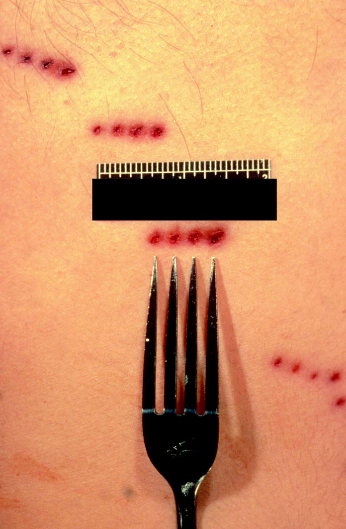 Sharp Force Injury Deaths SpringerLink