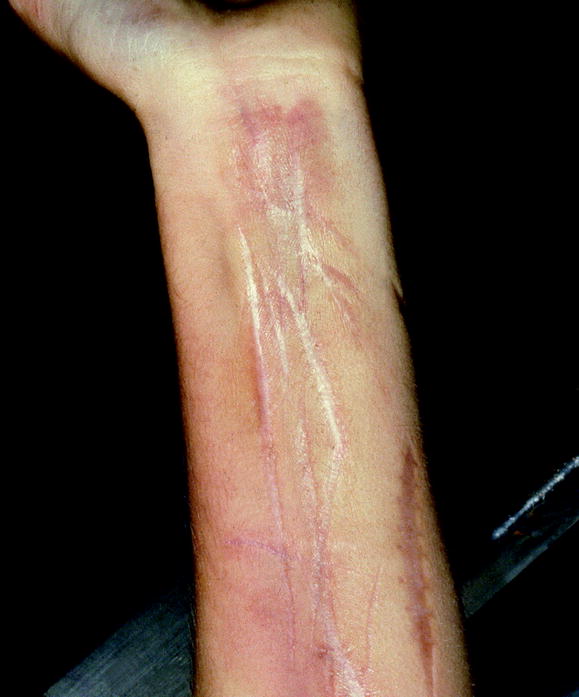 Sharp Force Injury Deaths SpringerLink