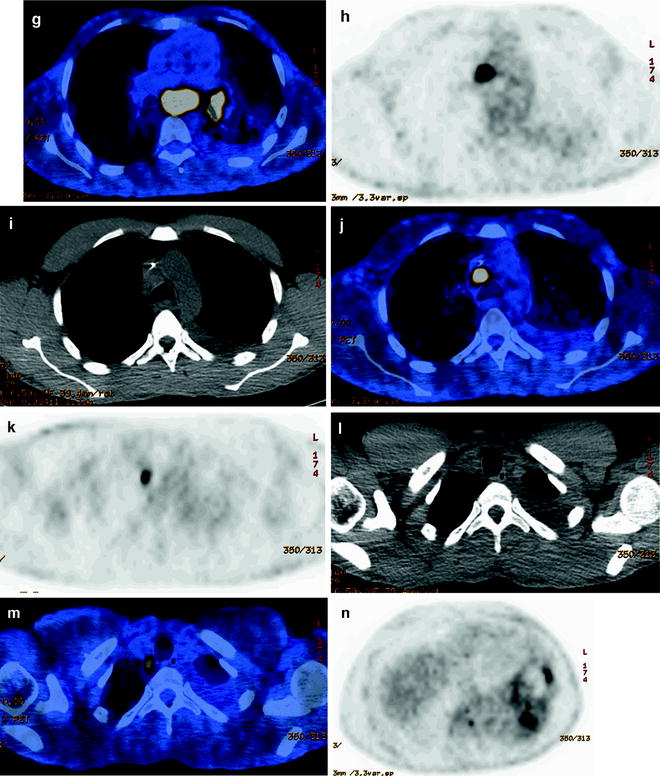 PET and PET-CT of Lung Cancer | SpringerLink
