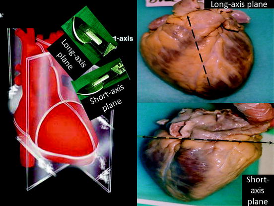 Sectioning of the Heart, Searching for Pathology Under the Microscope ...