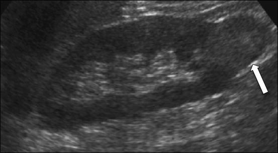 Imaging of Renal Cell Carcinoma | SpringerLink