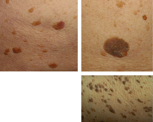 Evaluation of Malignant and Premalignant Skin Lesions | SpringerLink