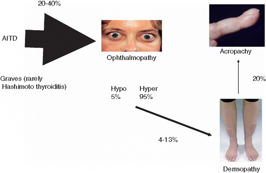 Pretibial Myxedema Thyroid Dermopathy Springerlink Pretibial Myxedema Thyroid Dermopathy Springerlink