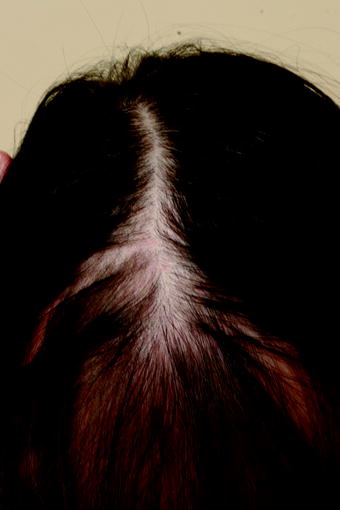 Alopecia And Thyroid Disease Springerlink