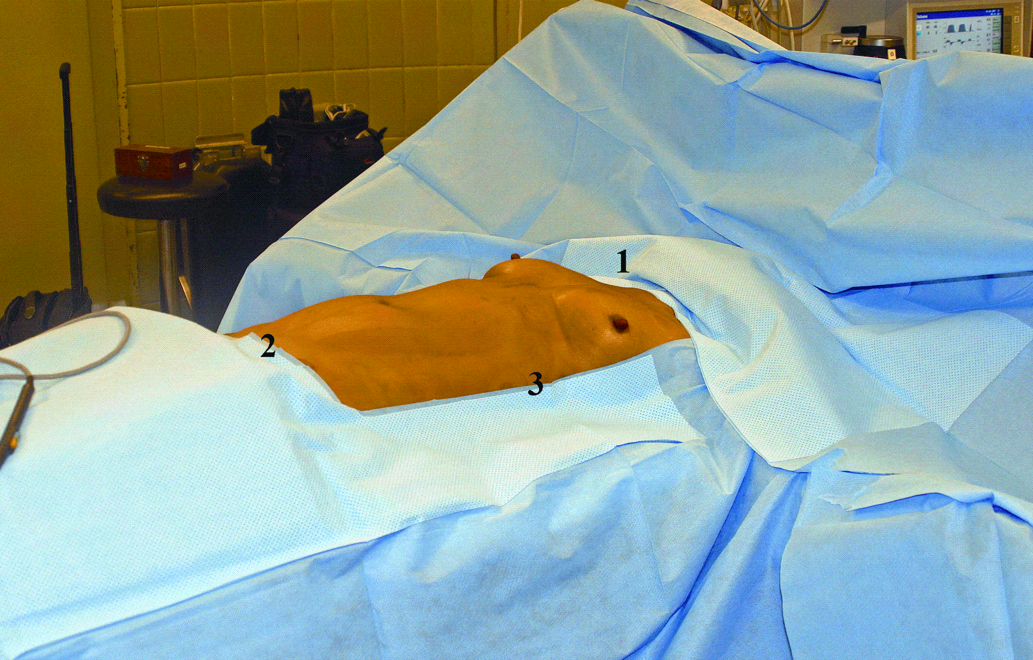 Preoperative Arrangements For Organ Donation Springerlink