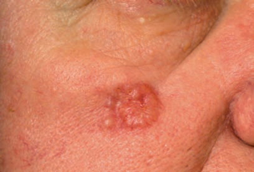 benign and malignant skin tumors springerlink
