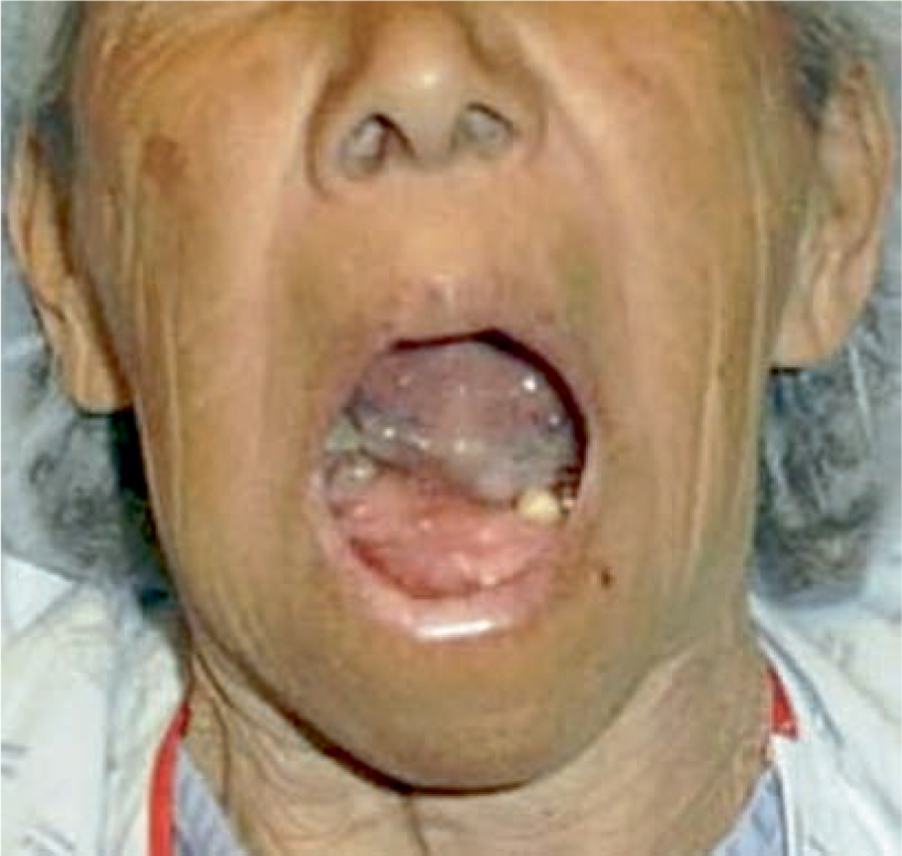 Benign and Malignant Tumors of the Head and Neck SpringerLink