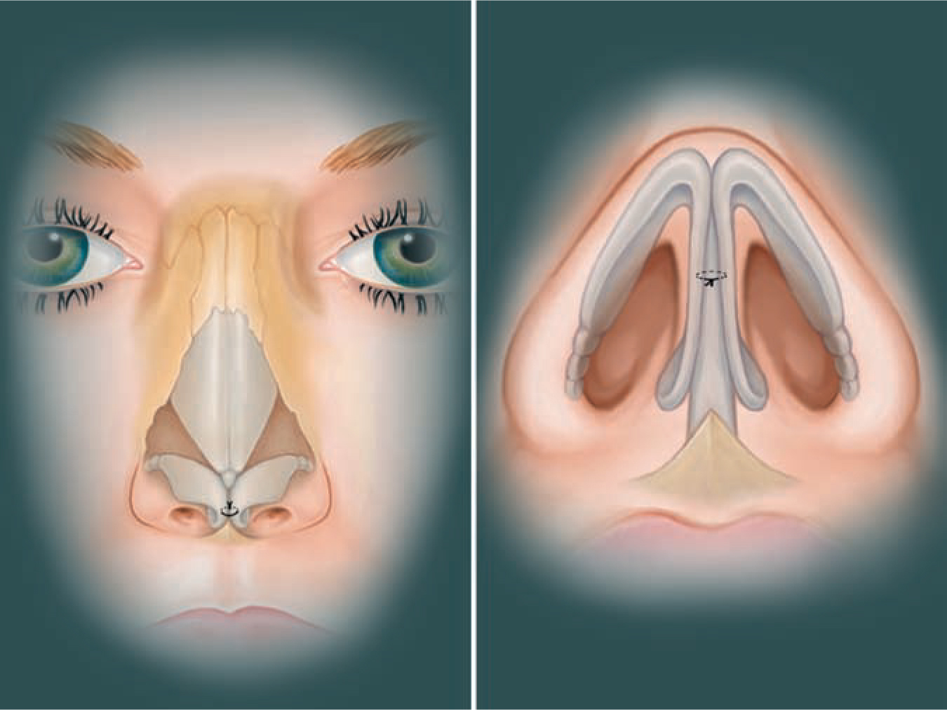 Nasal Reconstruction and Aesthetic Rhinoplasty | SpringerLink