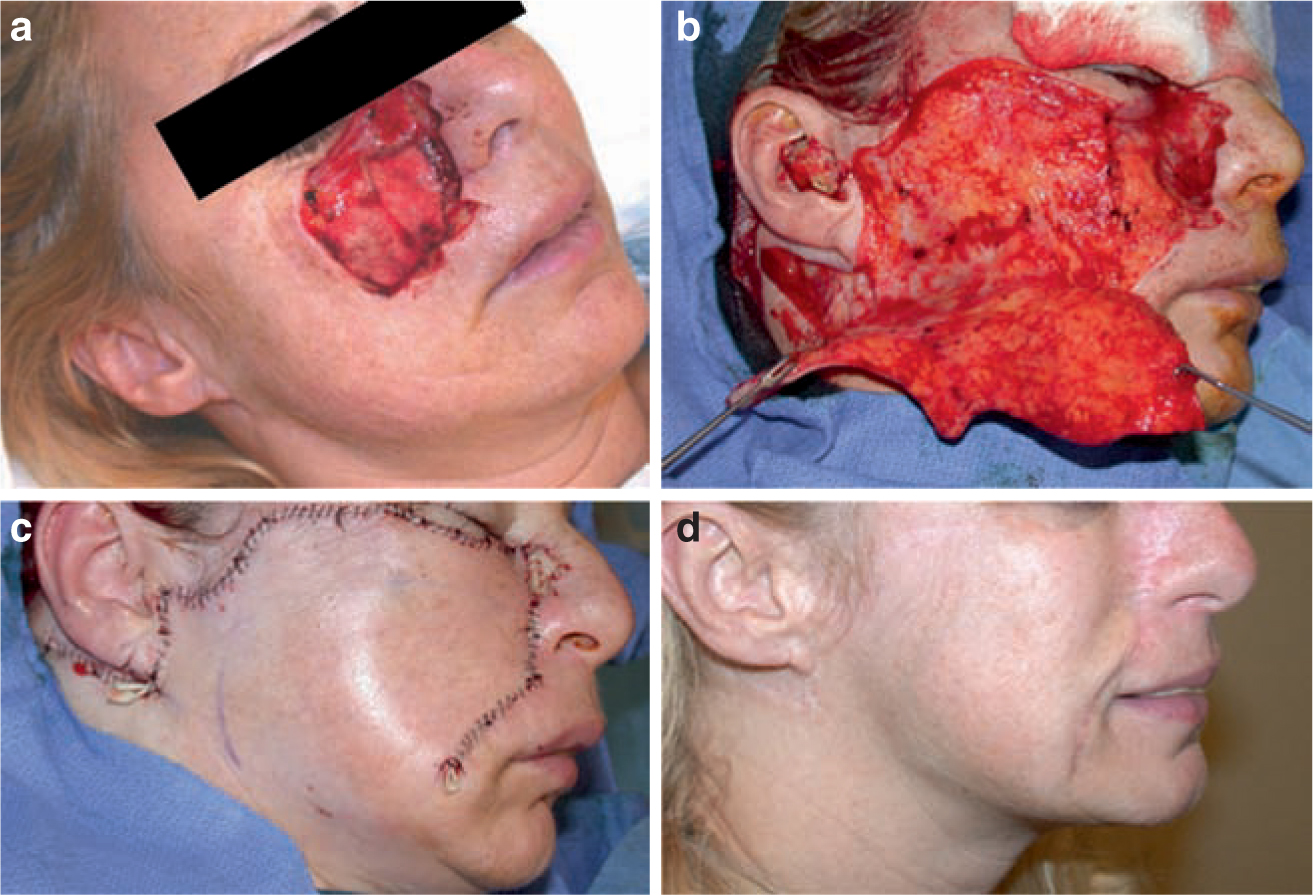 facial-lacerations-repair-emedicine-lindsay-lohan-sex-tape-free-view