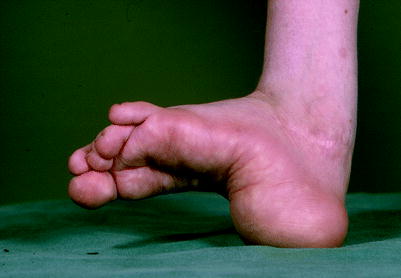 The Clubfoot Congenital Talipes Equinovarus Springerlink The Clubfoot Congenital Talipes Equinovarus Springerlink