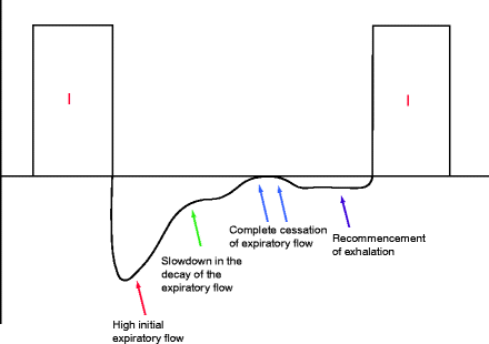 pip in mechanical ventilation pip in mechanical ventilation