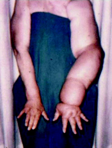 Management Of Upper Extremity Lymphoedema With Microsurgical Lympho Venous Anastomosis Lva Springerlink