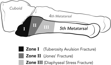 5th metatarsal fracture classification