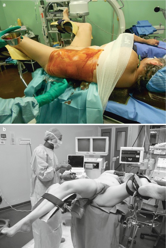 The Scrub Nurse S Point Of View On Ecirs Endoscopic Combined