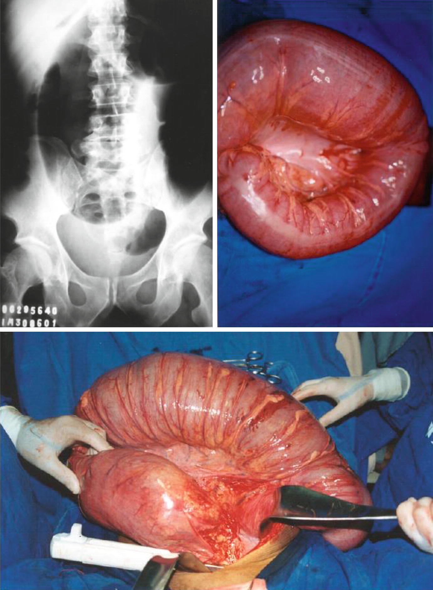 Gastrointestinal Chagas Disease Springerlink