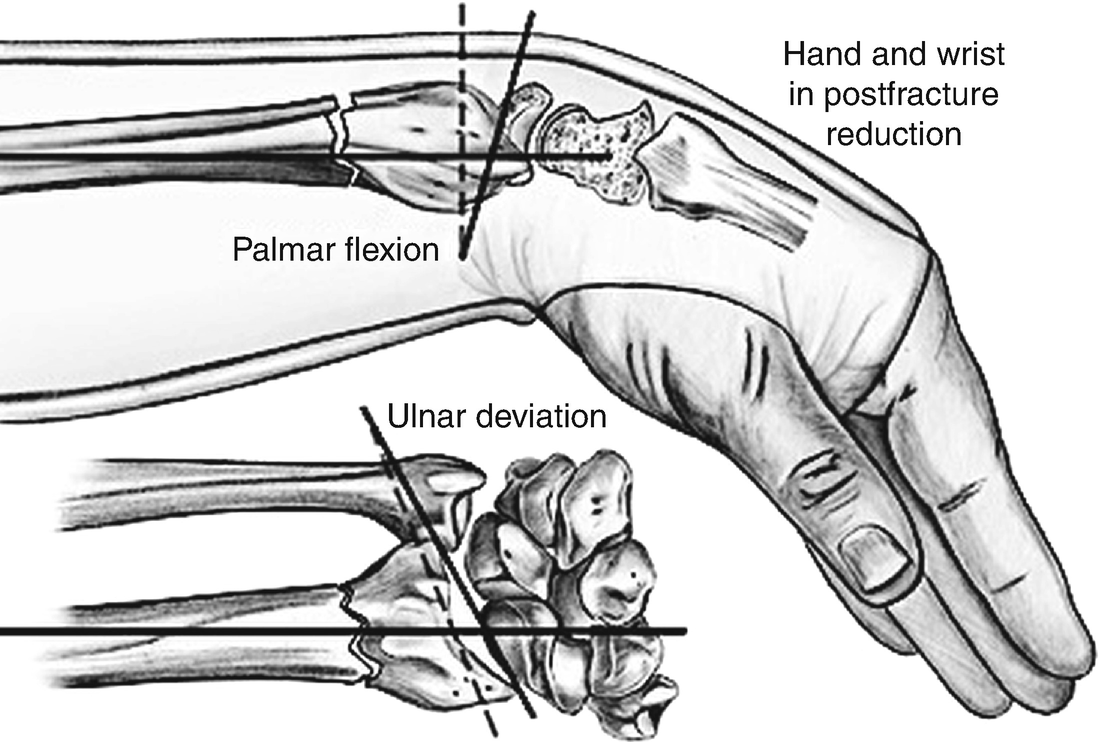 Distal Radius Springerlink