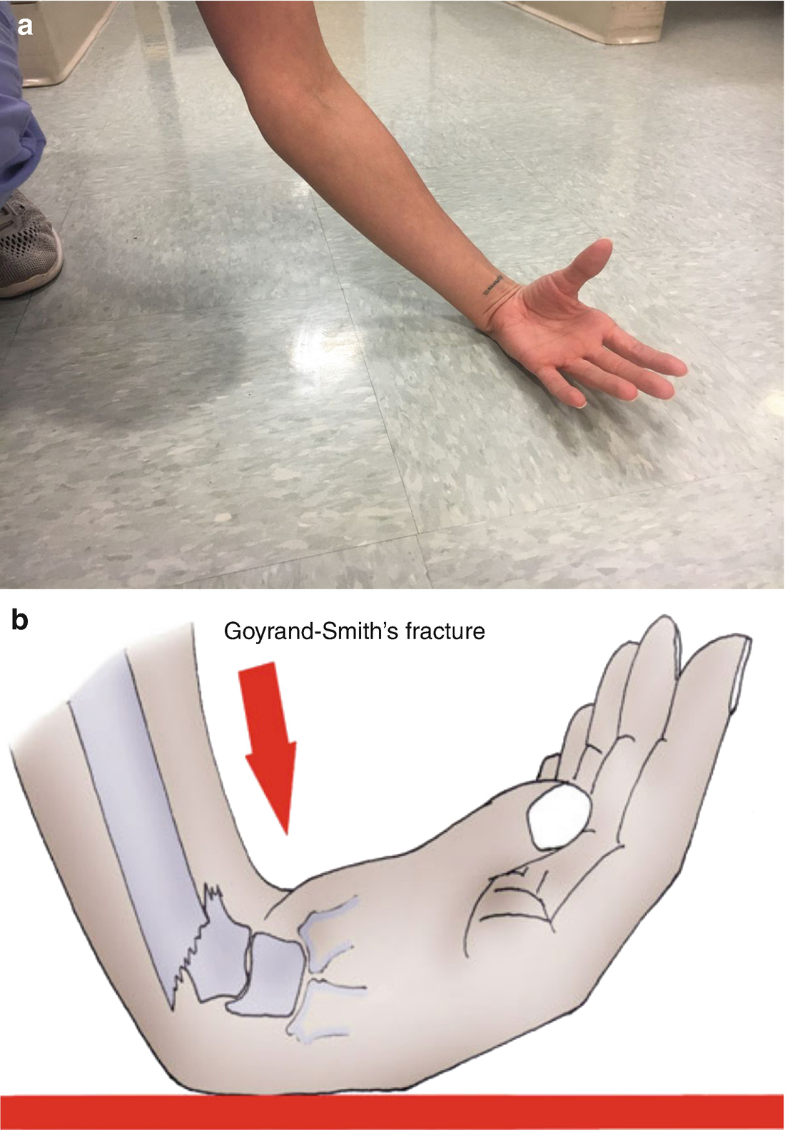 Distal Radius Springerlink