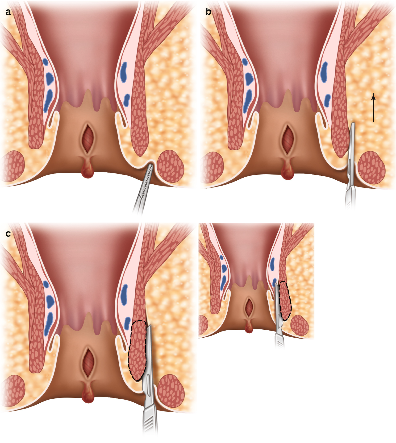 Anal stricture porn