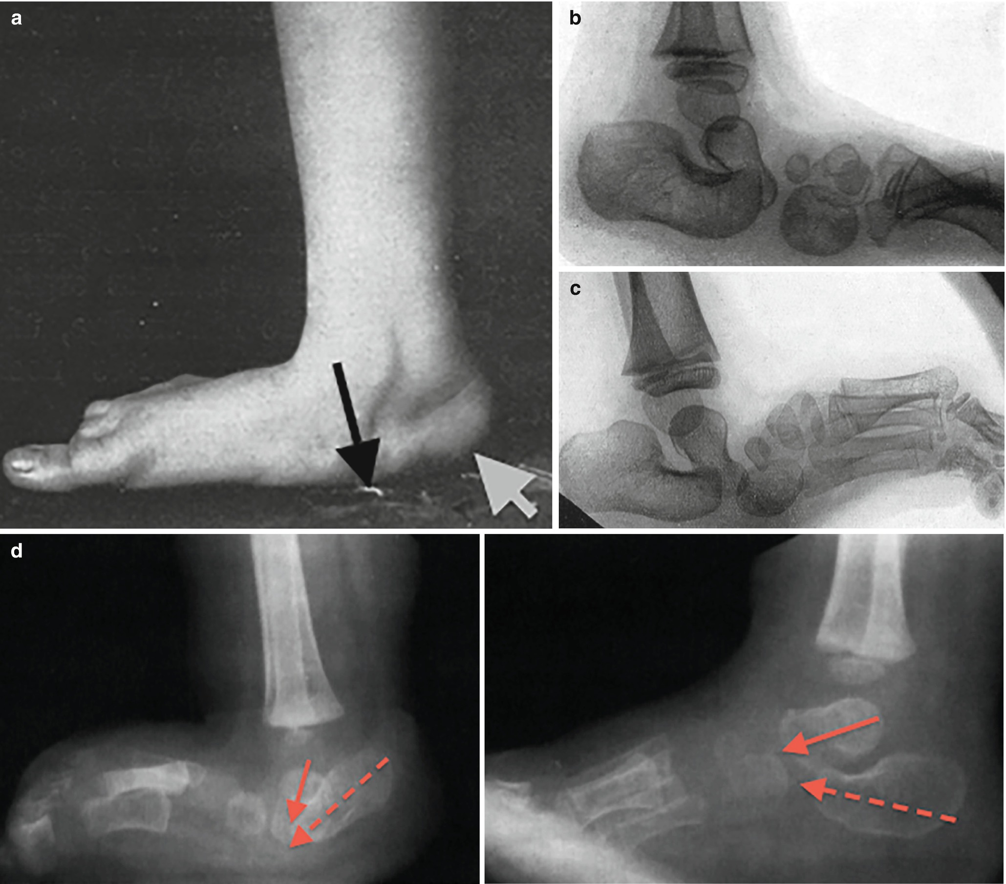 Developmental Disorders of the Foot and Ankle | SpringerLink