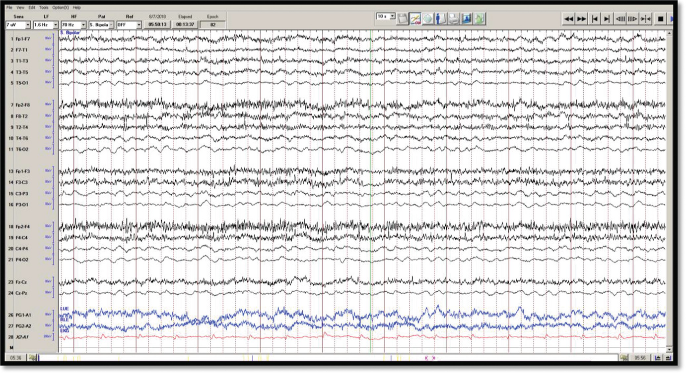 Anoxic Brain Injury Pleds Eeg