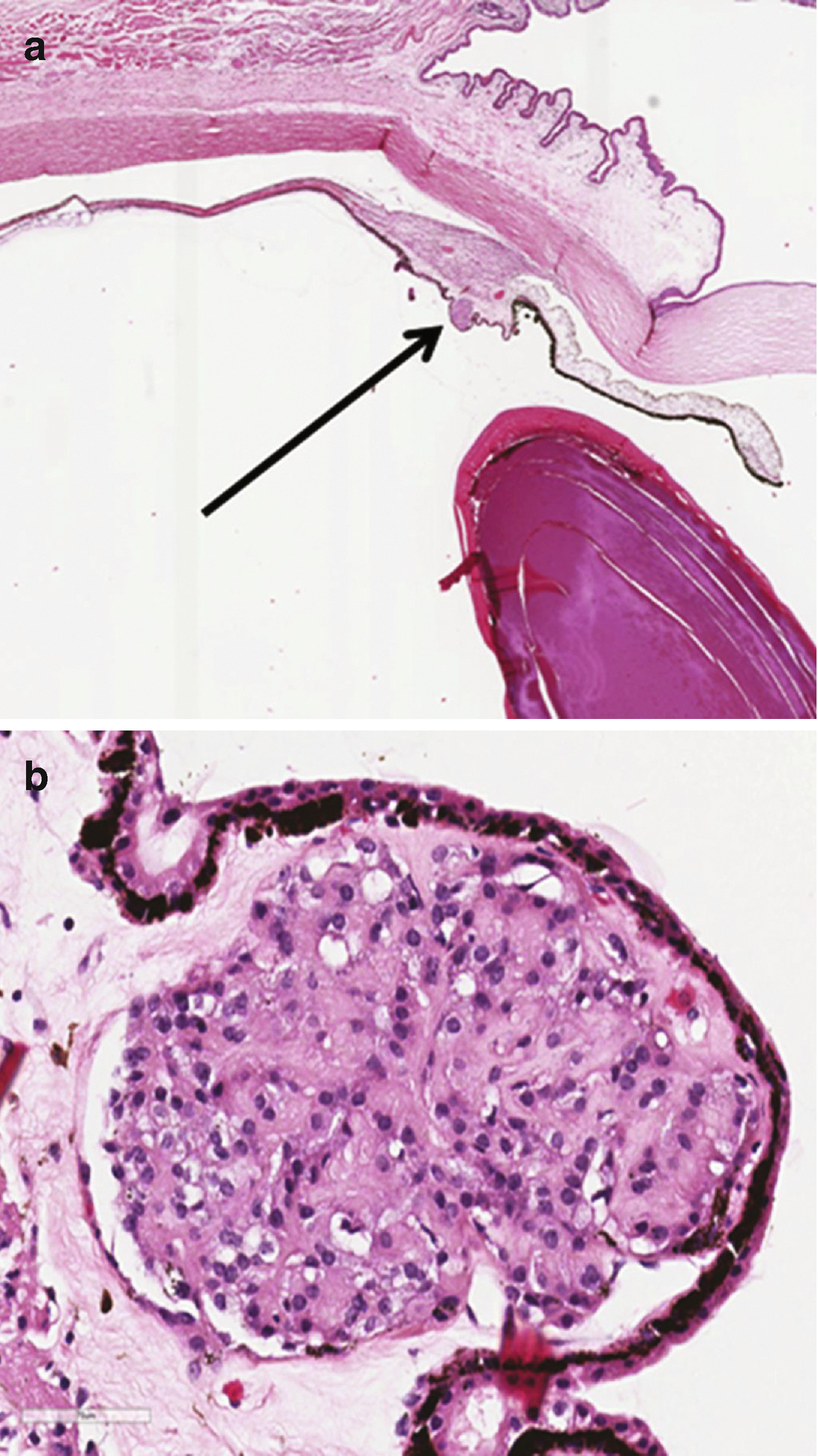 Tumors Of The Ciliary Epithelium Springerlink Tumors Of The Ciliary Epithelium Springerlink
