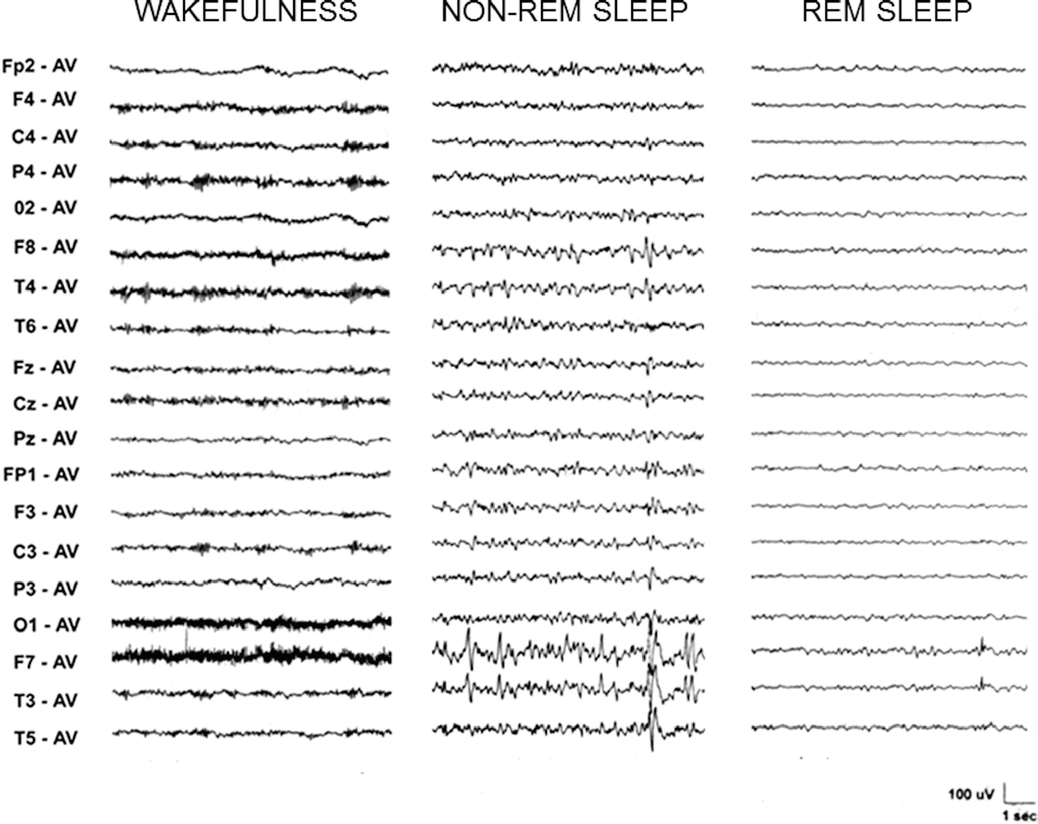 Non Age Related Focal Epilepsies Springerlink - 