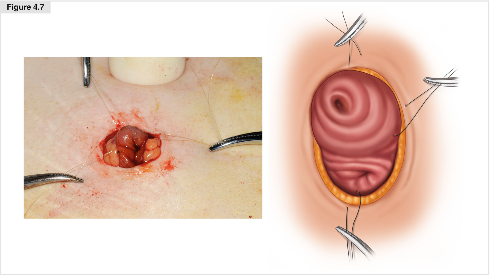 Laparoscopic Ileostomy And Colostomy For Faecal Diversion Springerlink